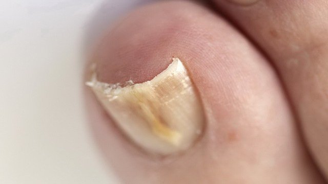 Грибок на тілі   типи грибка, симптоми, причини, профілактика