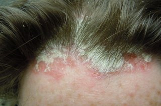 Трихомоніаз на голові   причини і лікування