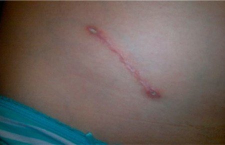 Шрам від апендициту: фото, методи позбавлення