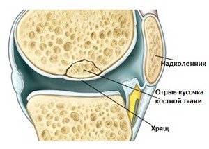 Чому виникає біль в коліні при ходьбі Чому виникає біль в коліні при ходьбі
