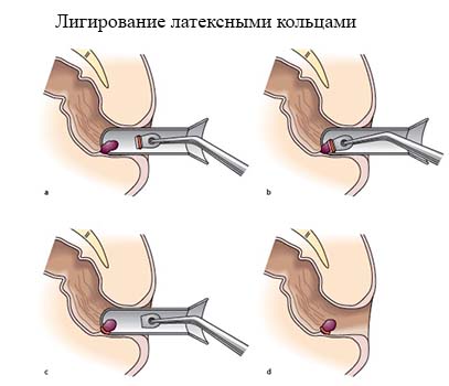 Як лікувати геморой після пологів