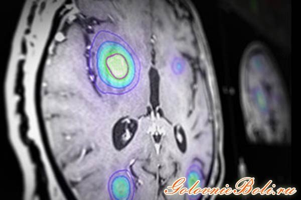 Метастази в головному мозку: лікування і тривалість життя