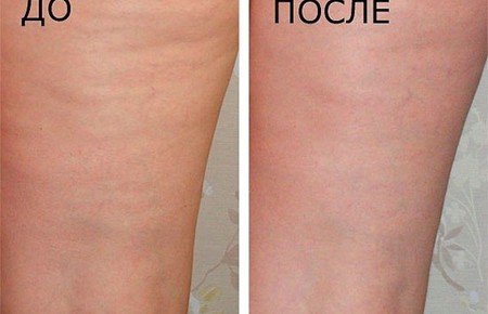 Медовий масаж від целюліту: фото до і після, відгуки