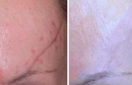 Видалення шрамів лазером: фото до і після, відгуки