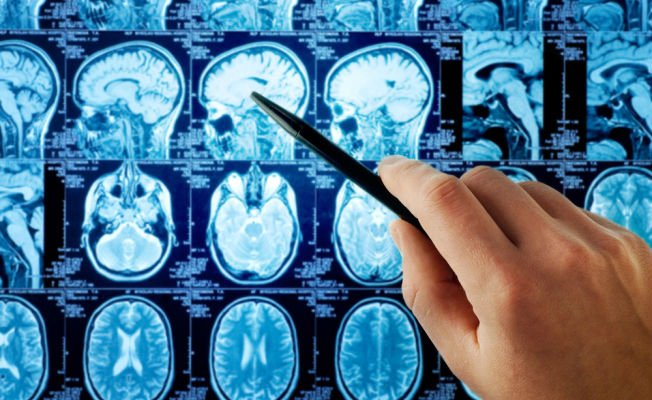 Пухлина головного мозку: причини, симптоми і лікування
