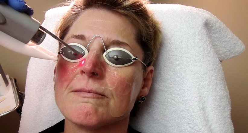 Розацеа   причини, симптоми, методи лікування