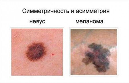 Онкологія родимки: фото та ознаки меланоми Онкологія родимки: фото та ознаки меланоми