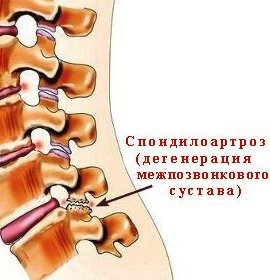 Спондилоартроз попереково крижового відділу хребта: симптоми і лікування