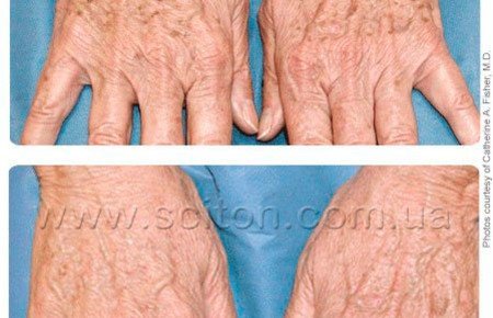 Пігментні плями на руках: причини і методи лікування