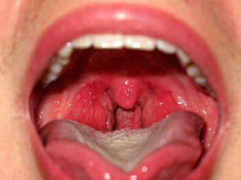 Аденоїдит у дітей: симптоми і лікування Аденоїдит у дітей: симптоми і лікування