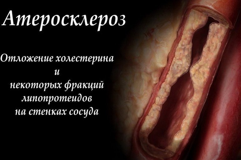 Липоевая кислота для снижения холестерина отзывы