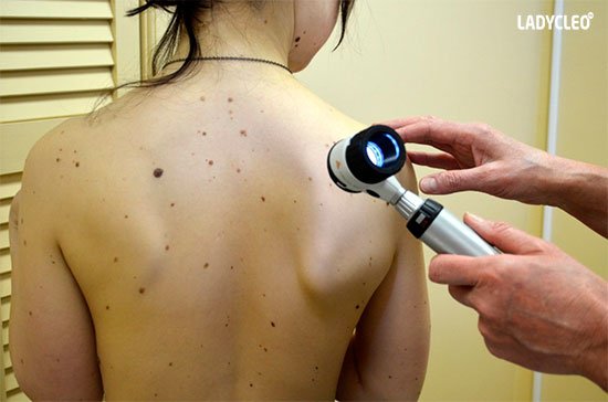 Пігментні плями на спині: причини, види, як позбутися