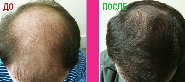 Platinus V Professional   засіб для росту і відновлення волосся