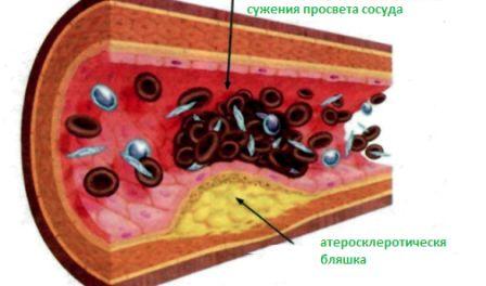 Підвищений холестерин у жінок: про що це говорить і що треба робити