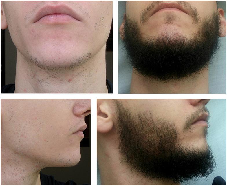 4 правила використання Міноксидилу для бороди
