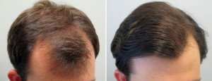 Лосьйон міноксидил: середня ціна засоби для волосся і застосування