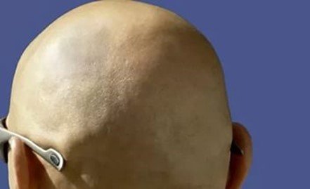 Тотальна алопеція (випадіння волосся) у чоловіків і жінок: причини і лікування