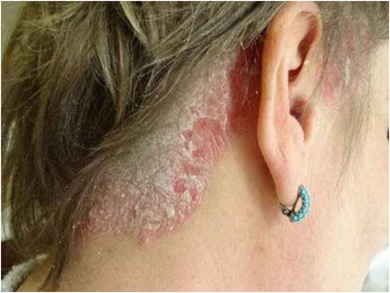 Себорейний дерматит волосистої частини голови: чим лікувати шкіру, причини недуги