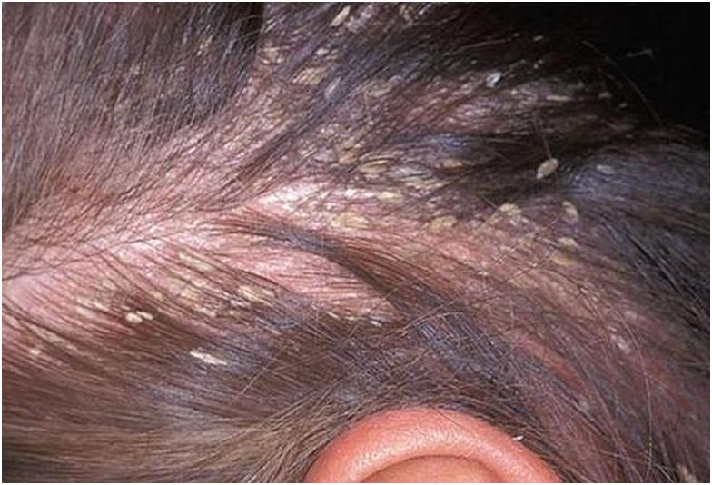 Себорея шкіри голови, її лікування в домашніх умовах і види: жирна і суха форма