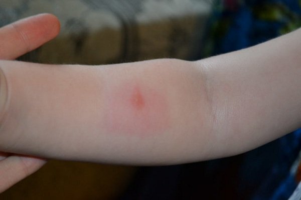 Алергія на комарів у дітей і дорослих: основні симптоми алергічної реакції і лікування