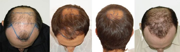Як запобігти і зупинити випадіння волосся у чоловіків: ефективні способи