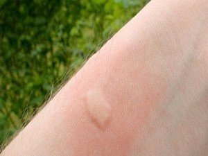Як позбутися свербіння від укусу комарів: найбільш ефективні способи
