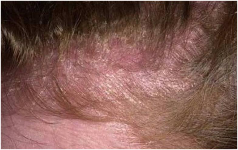 Себорея шкіри голови, її лікування в домашніх умовах і види: жирна і суха форма