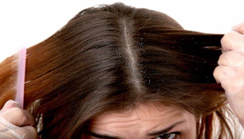 Сильна жирна лупа і випадання волосся: вибираємо шампунь для лікування