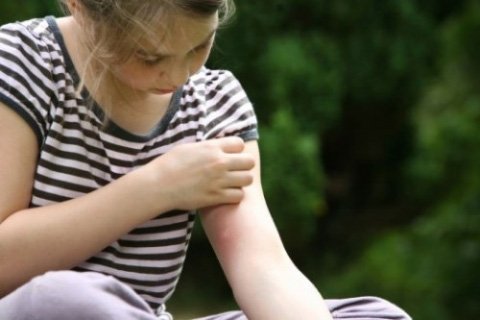 Алергія на укуси комарів: алергічна реакція і методи лікування