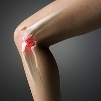 Лікування артрозу колінного суглоба   медикаментозна та домашня терапія