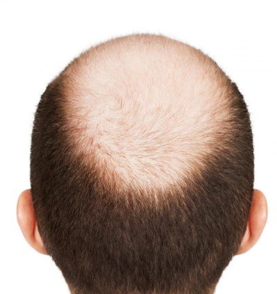 Тотальна алопеція (випадіння волосся) у чоловіків і жінок: причини і лікування