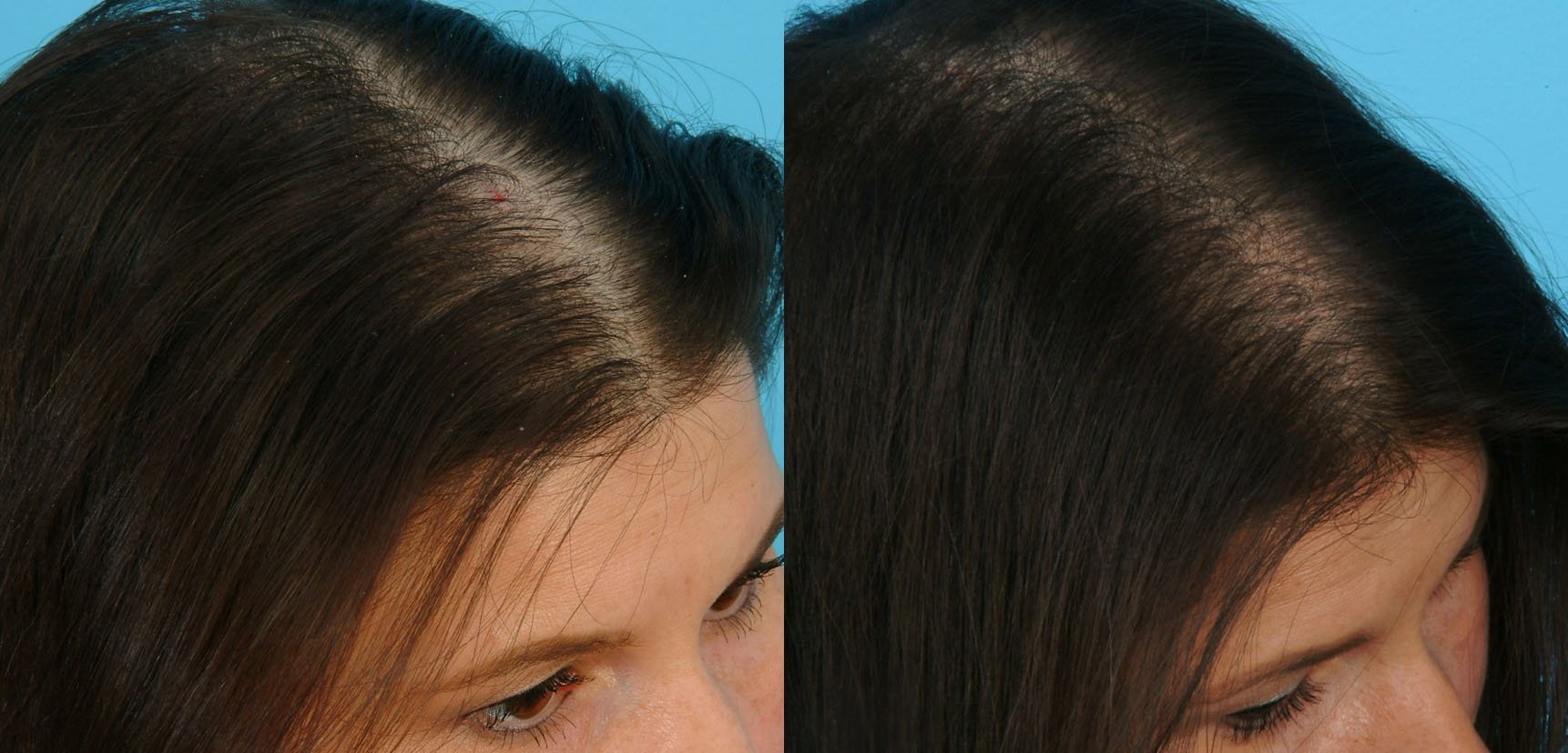 Мезороллер для волосся і шкіри голови: застосування в салоні і домашніх умовах