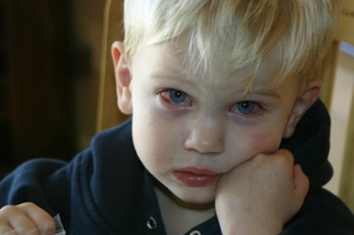 Конюнктивіт: симптоми і лікування у дітей