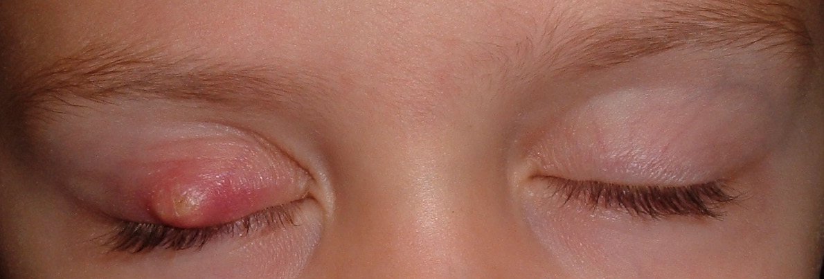 Ячмінь на оці у дитини: як лікувати