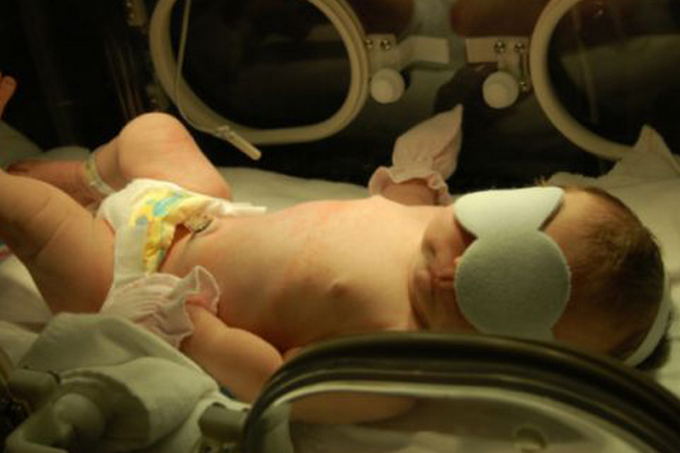 Жовтяниця у новонароджених: причини і наслідки