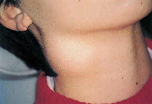 Збільшені лімфовузли на шиї у дитини: причини