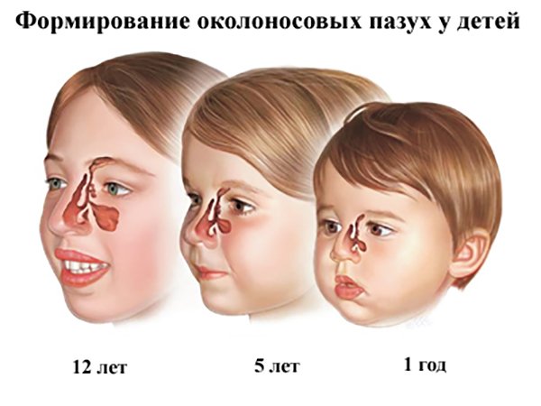 Синусит у дитини: симптоми і лікування