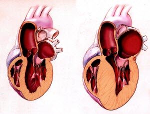 Збільшення лівого шлуночка серця