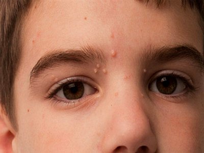 Кандидозний молюск у дітей і дорослих: симптоми і лікування