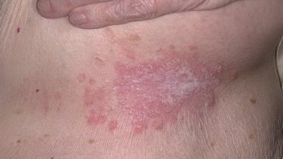 Дріжджовий грибок на шкірі у жінок: лікування і симптоми