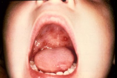 Герпесу 6 типу у дітей: симптоми і лікування