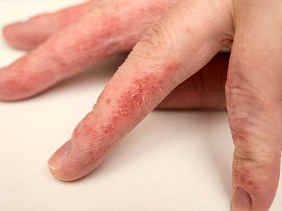 Екзема на пальцях рук: лікування болячок маззю та іншими ліками