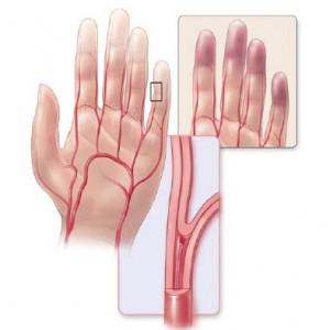 Німіють кінчики пальців на руках: причини, діагностика, лікування