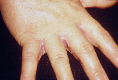 Тріскається шкіра на подушечках пальців рук: причини і лікування