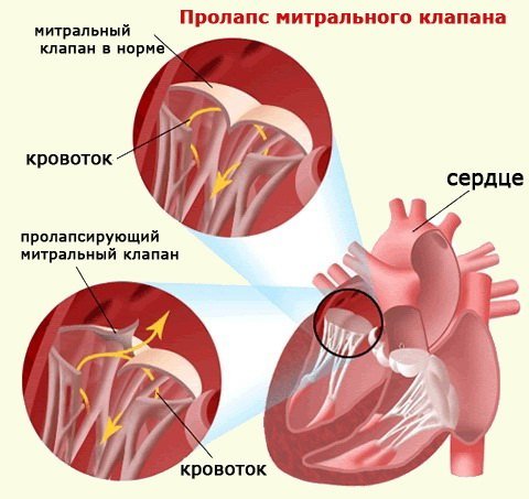 Порок серця у дитини: симптоми