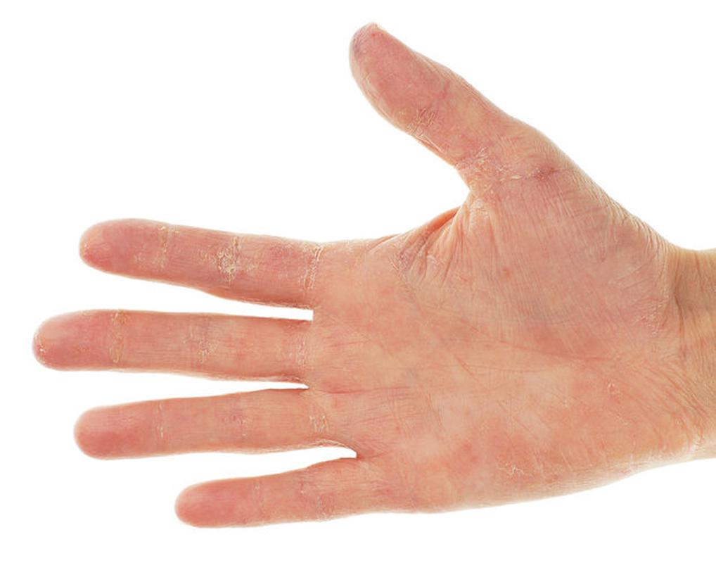 Лопнула шкіра на пальці руки до крові: причини і лікування для жінок