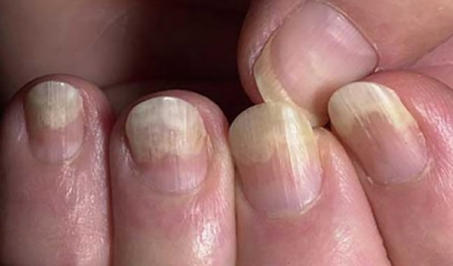 Нігті на руках відходять від шкіри: причини і лікування відшарування нігтів