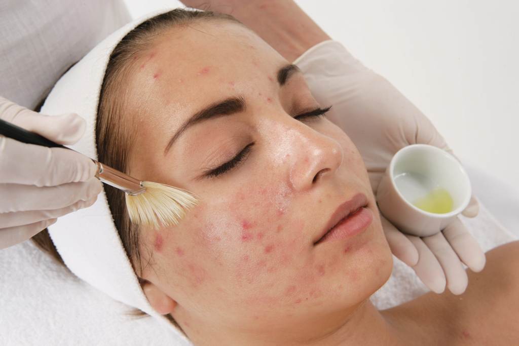 Про купероз на шкірі обличчя: причини і профілактика, способи лікування захворювання