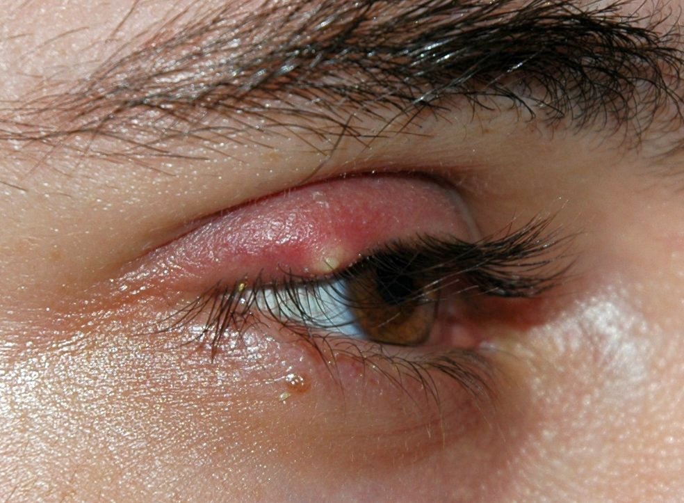 Про лікування вій: як лікувати і що робити, якщо свербить верхнє повіку ока