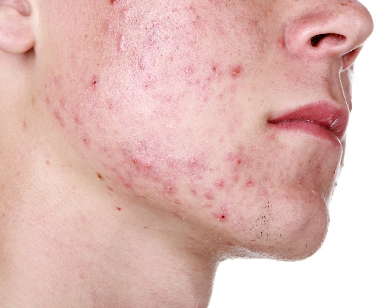 Про пінку для вмивання від прищів: причини і лікування червоних плям на шкірі обличчя